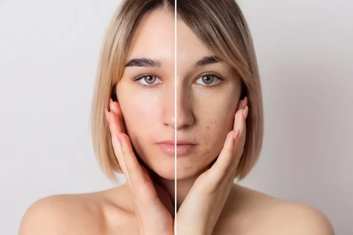 Cómo Mejorar el Acné Hormonal: La Guía de Alimentación 💆‍♀️