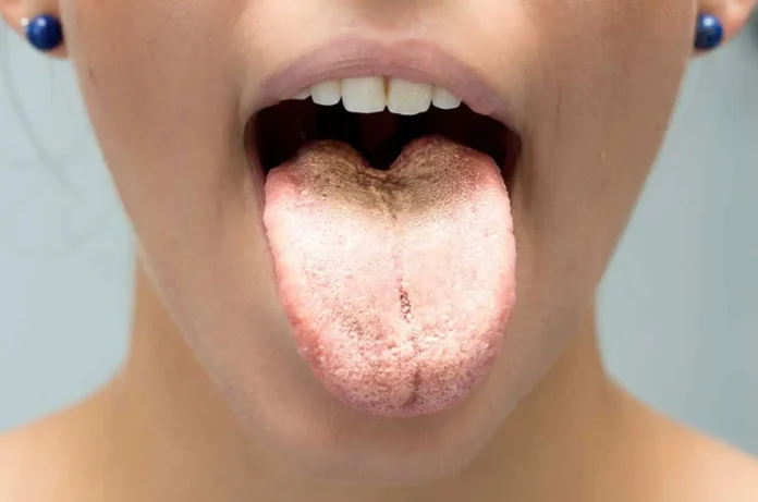 ¿Cómo Saber si Tengo Cándida en mi Cuerpo? 🍄 10 Síntomas Clave