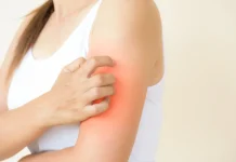 ¿Cómo Saber si Tengo Mucha Histamina en el Cuerpo? 7 Señales Clave