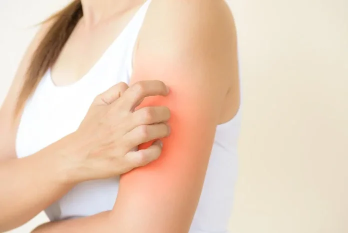 ¿Cómo Saber si Tengo Mucha Histamina en el Cuerpo? 7 Señales Clave